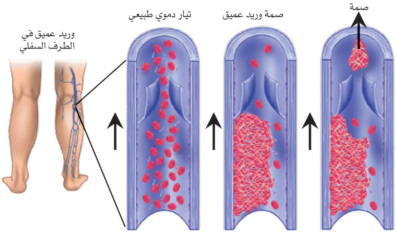 التهاب وريد خثري عميق
