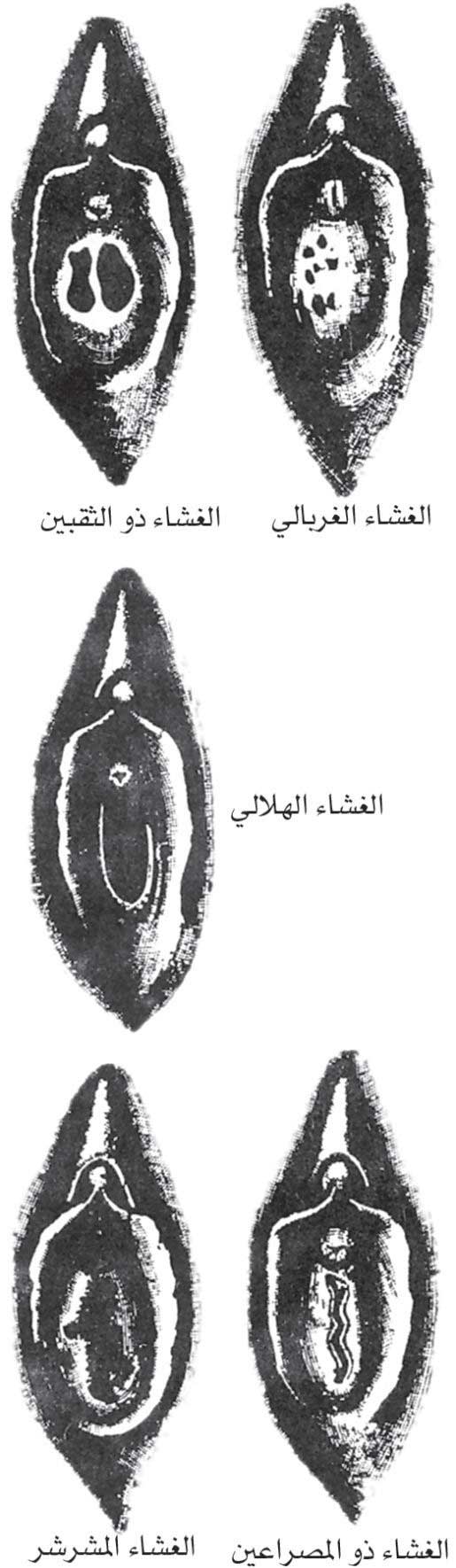 الموسوعة العربية | عدم انثقاب غشاء البكارة