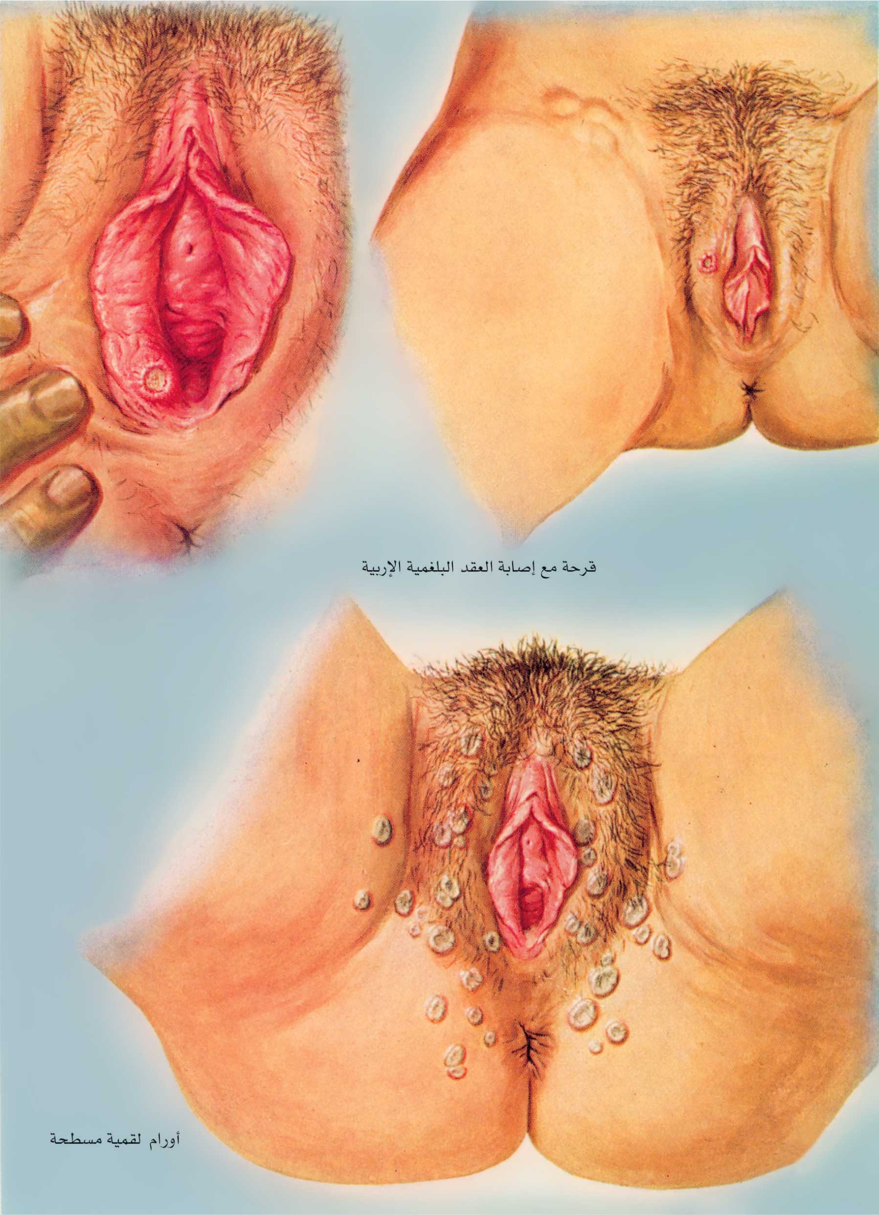чем можно заразится сифилисом при мастурбации (120) фото