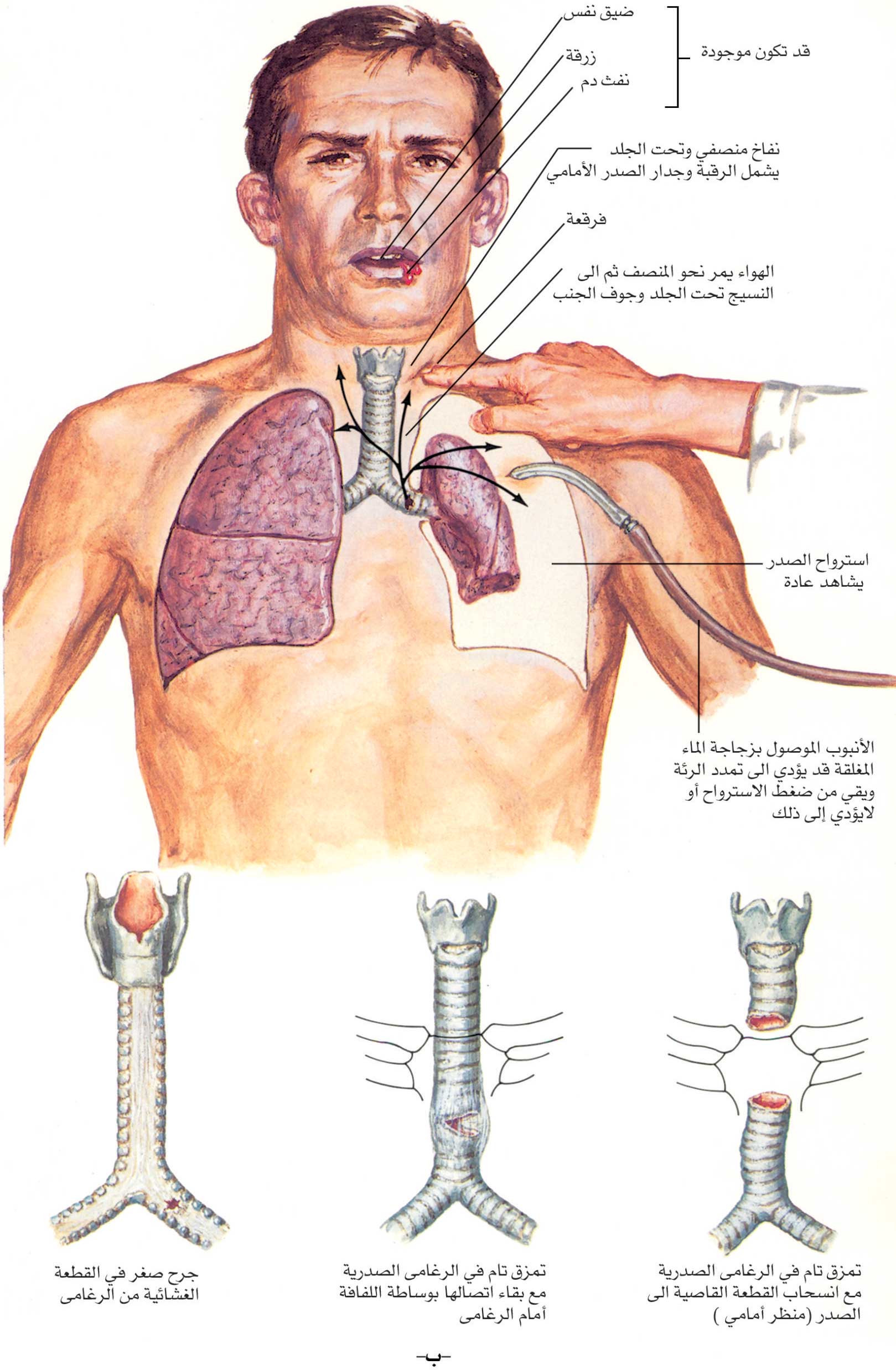 الموسوعة العربية | آفات الرئة الجراحية