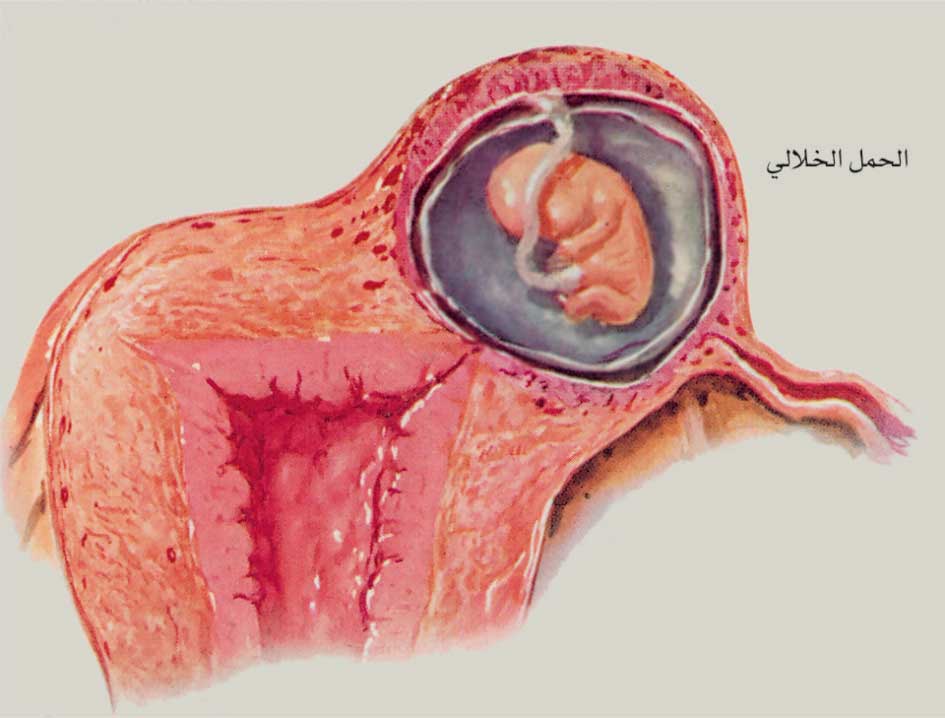 الموسوعة العربية | الحمل خارج الرحم